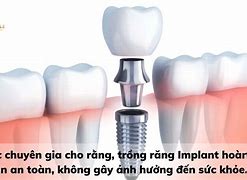 Trồng Răng Implant Có Nguy Hiểm Không