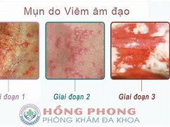 Vùng Kín Bị Hôi Phải Làm Sao